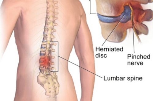 Lumbar Microdiscectomy